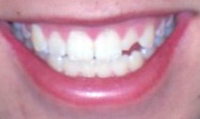 dental injury